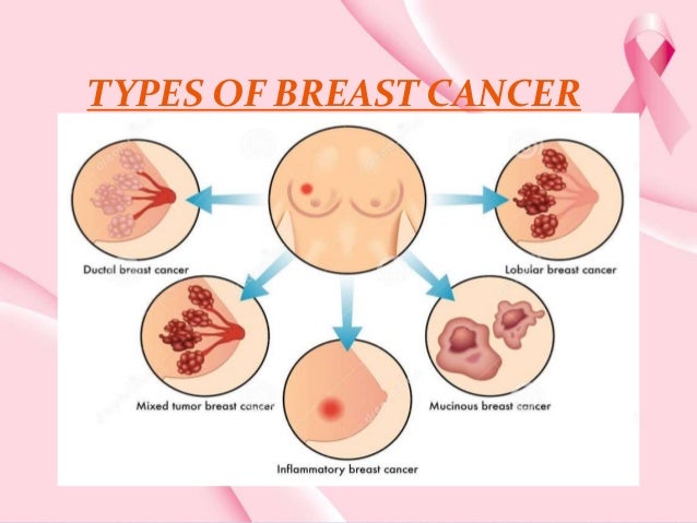chemotherapy after breast cancer Chemotherapy after breast cancer